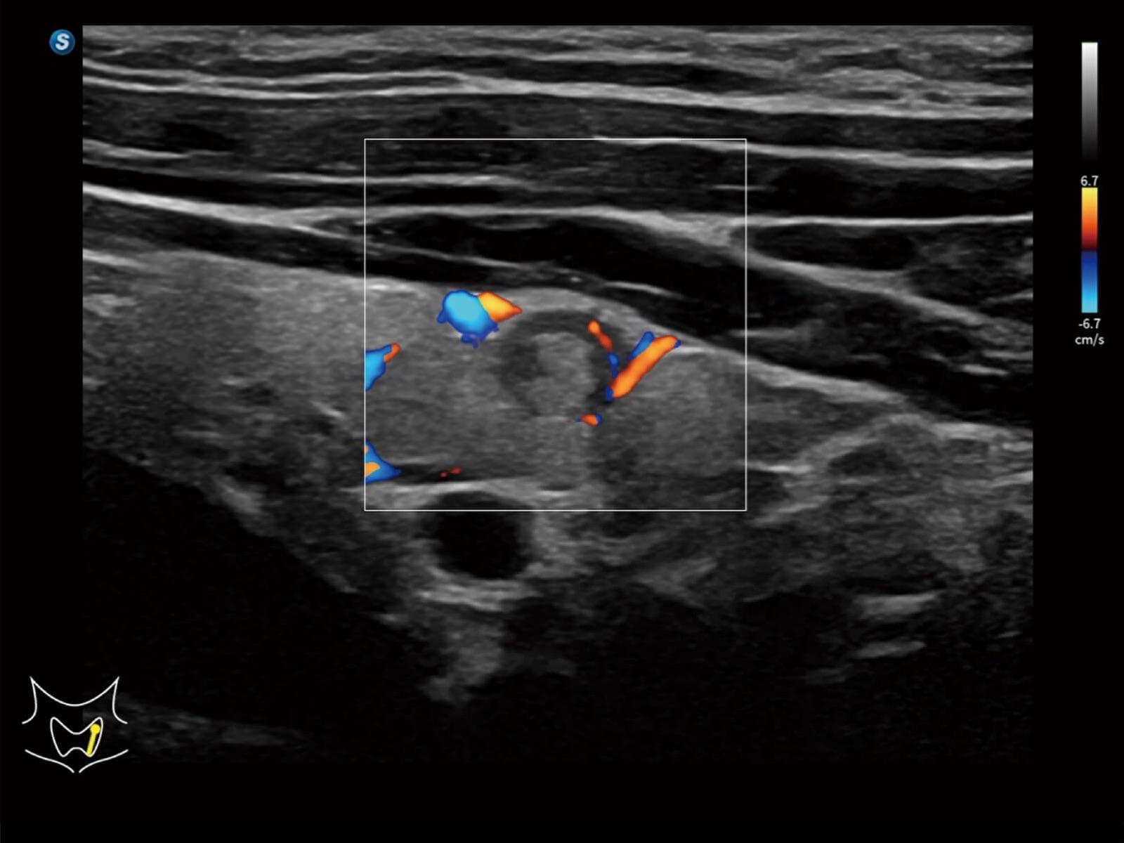 Flusso SR del carcinoma papillare della tiroide