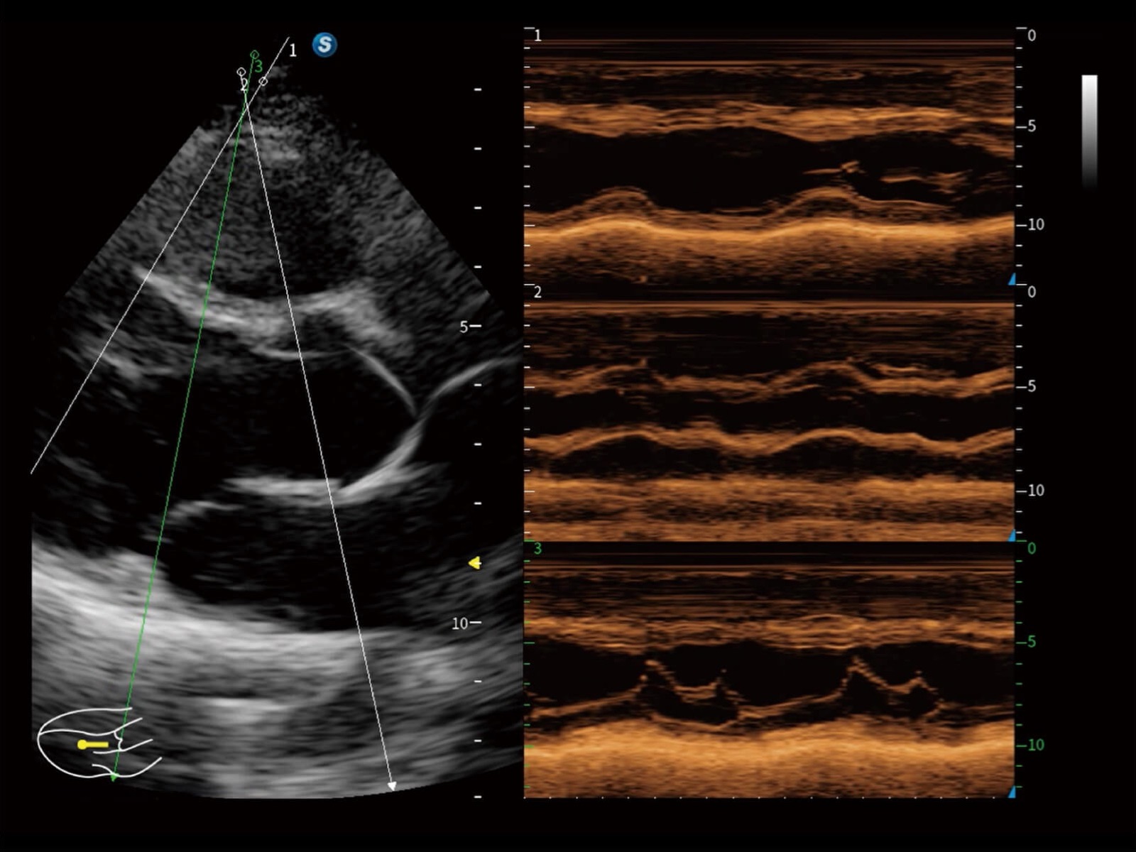 AMM cardiaco