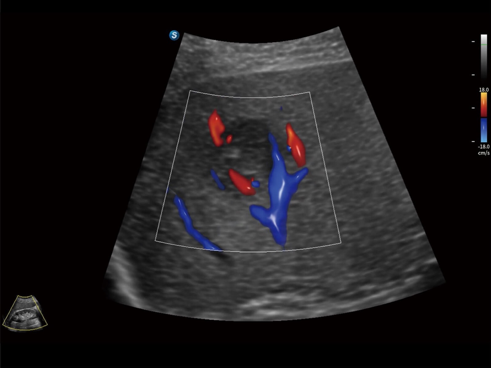Bright Flow di calcificazione delle arterie epatiche
